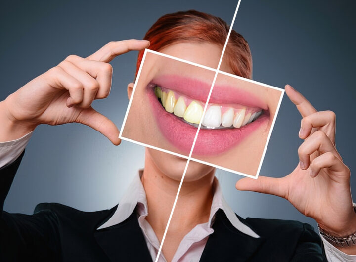 Na czym polega wybielanie zębów