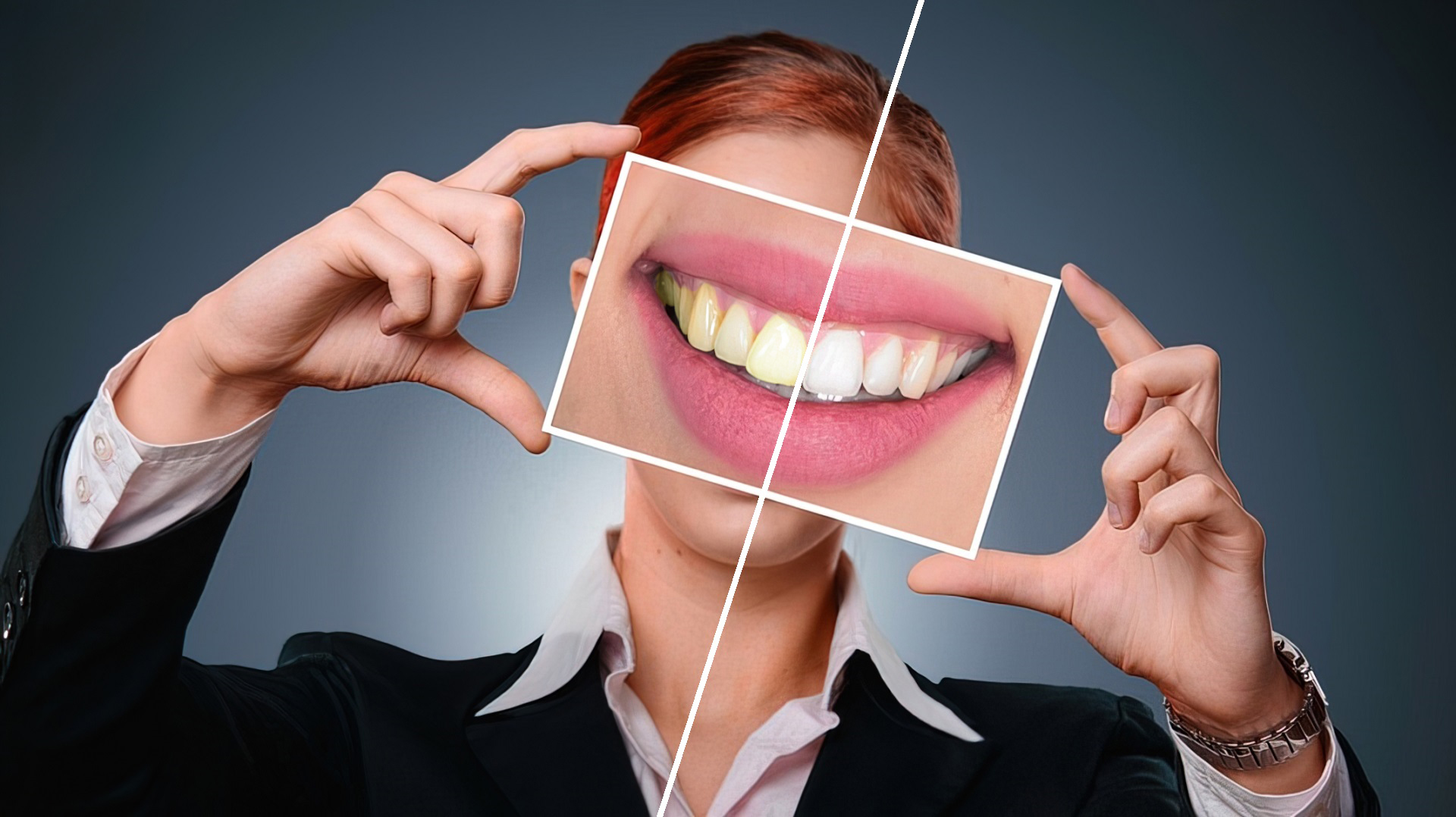 Na czym polega wybielanie zębów